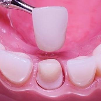 Dental Crown